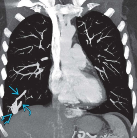 Dị dạng động-tĩnh mạch phổi (Pulmonary arteriovenous malformation - PAVM)