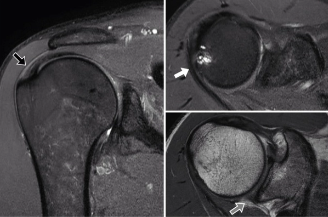 Hội chứng chèn ép khớp vai sau-trên (Posterosuperior impingement of the shoulder)/ Hội chứng chèn ép trong khớp vai (Internal Impingement)
