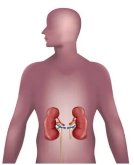 Bể thận ngoài thận (Extrarenal pelvis)