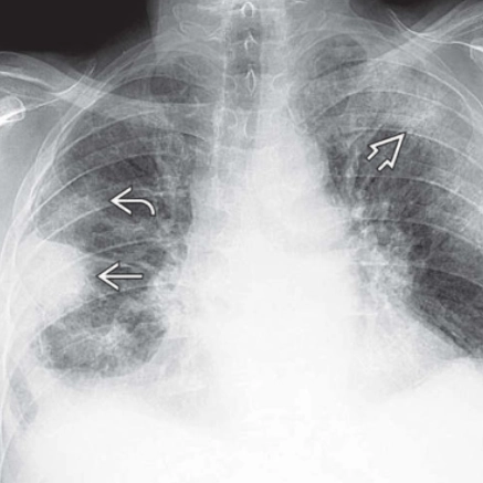Viêm phổi tăng bạch cầu ái toan mạn tính (Chronic Eosinophilic Pneumonia - CEP)