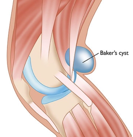 Nang Baker (Baker cyst)/Nang khoeo (Popliteal cyst).