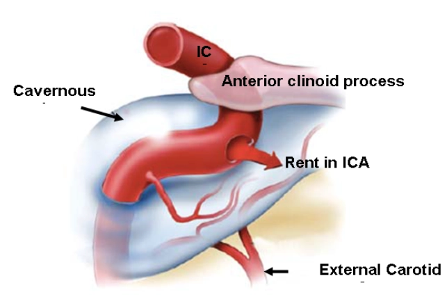 Rò động mạch cảnh- xoang hang (Caroticocavernous Fistulas - CCFs) 