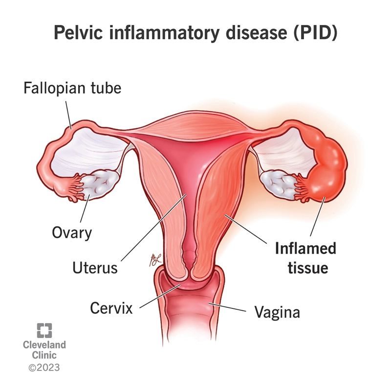 Viêm vùng chậu (Pelvic Inflammatory Disease - PID)