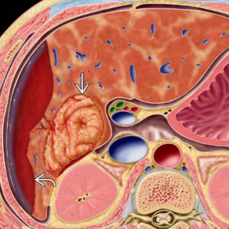 Adenoma tế bào gan (Hepatocellular Adenoma - HCA)