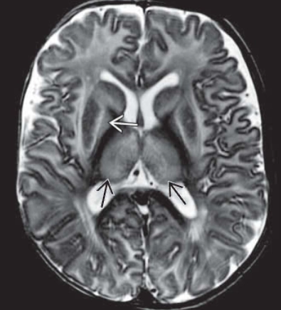 Bệnh Canavan (Canavan Disease)