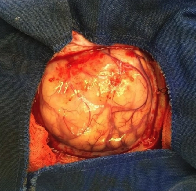 Nhiễm nấm Cryptococcus hệ thần kinh trung ương (CNS Cryptococcosis)