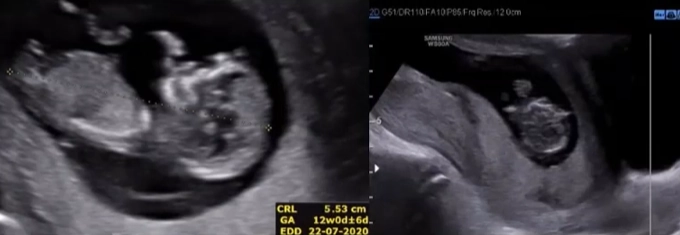 Tổng quan bánh nhau và dây rốn (Approach to the Placenta and Umbilical Cord)