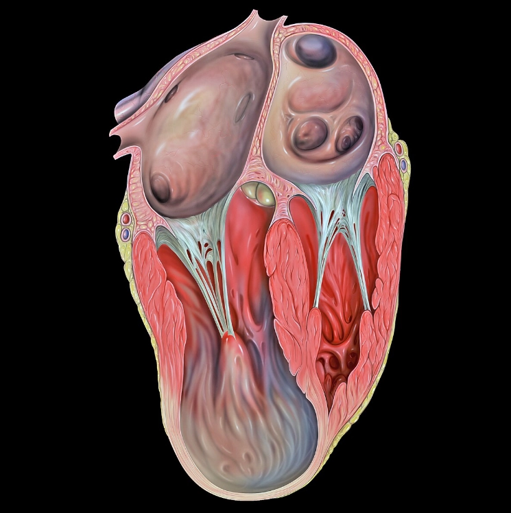 phình/ túi thừa tâm thất