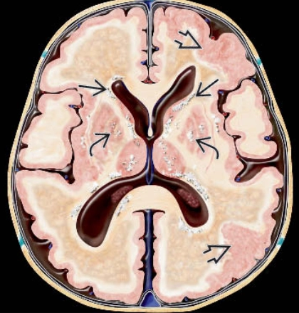 Nhiễm Cytomegalovirus bẩm sinh (Congenital Cytomegalovirus- CMV )