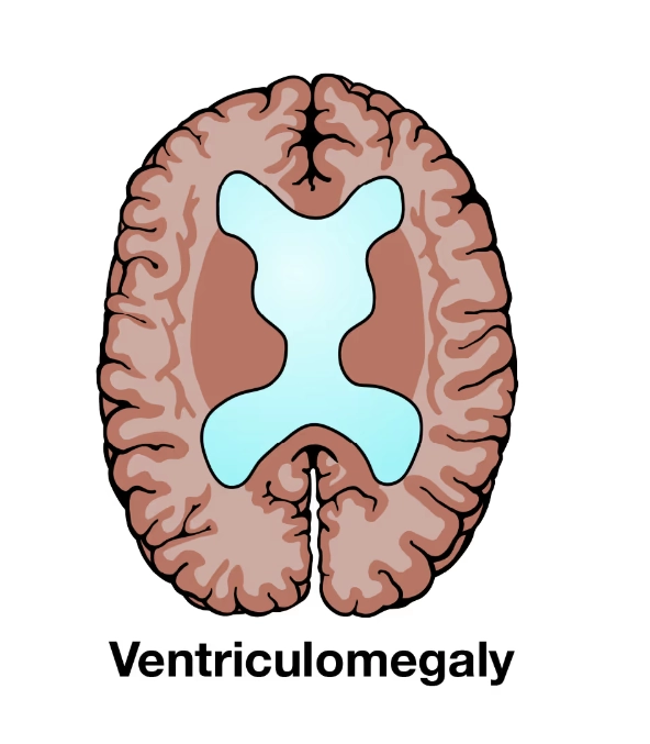 Giãn não thất thai nhi (Ventriculomegaly)