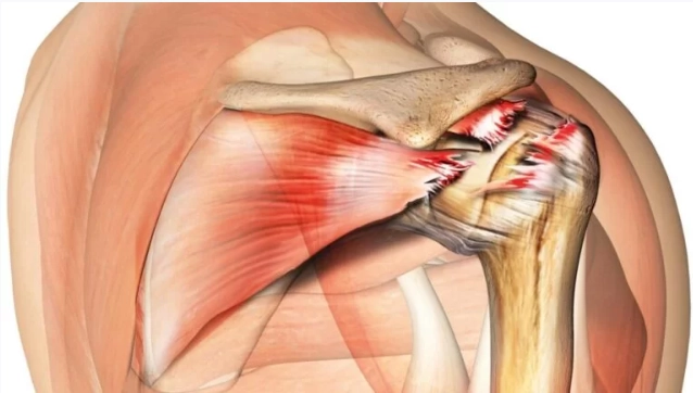 Rách gân cơ dưới gai (Infraspinatus tendon tear)