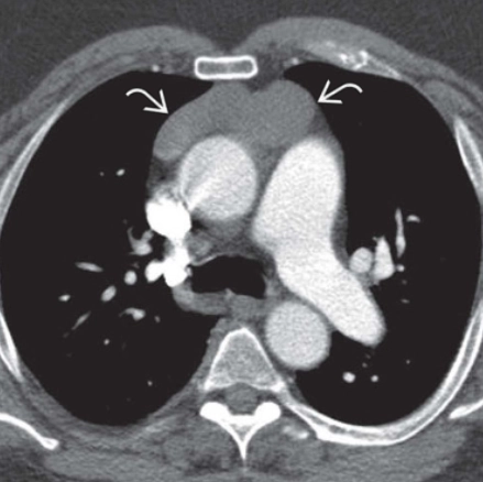 Nang tuyến ức (Thymic cyst)