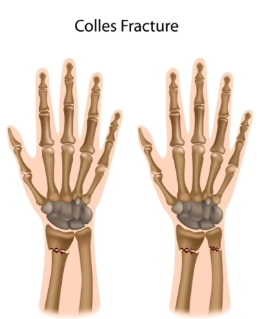 Gãy Colles (Colles fracture)