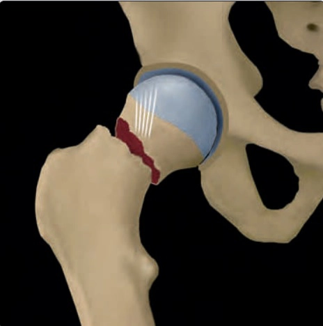 Đại cương gãy xương (Skeletal Trauma)