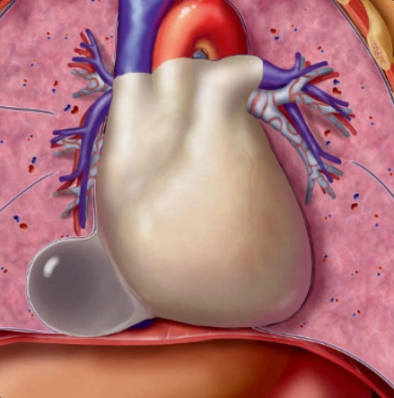 Nang màng ngoài tim (Pericardial Cyst)