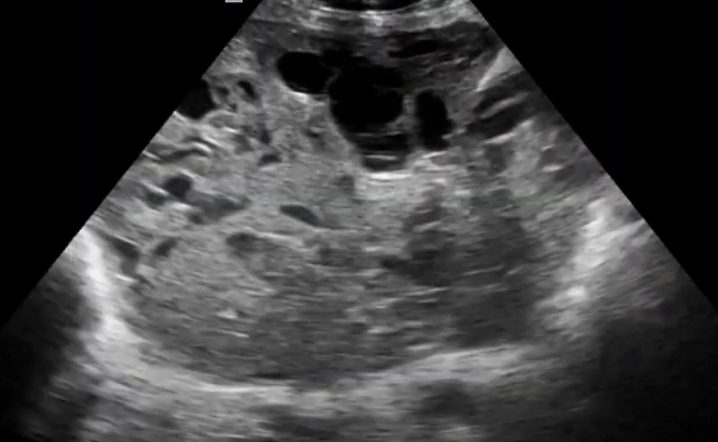 Loạn sản trung mô bánh nhau (Placental Mesenchymal Dysplasia - PMD)