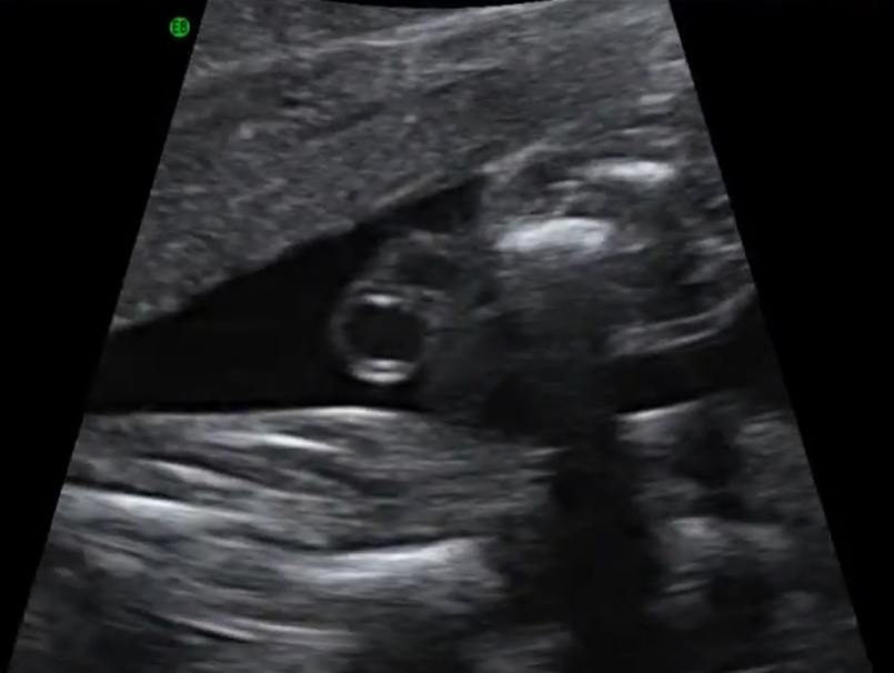 Dây rốn một động mạch (Single Umbilical Artery - SUA)