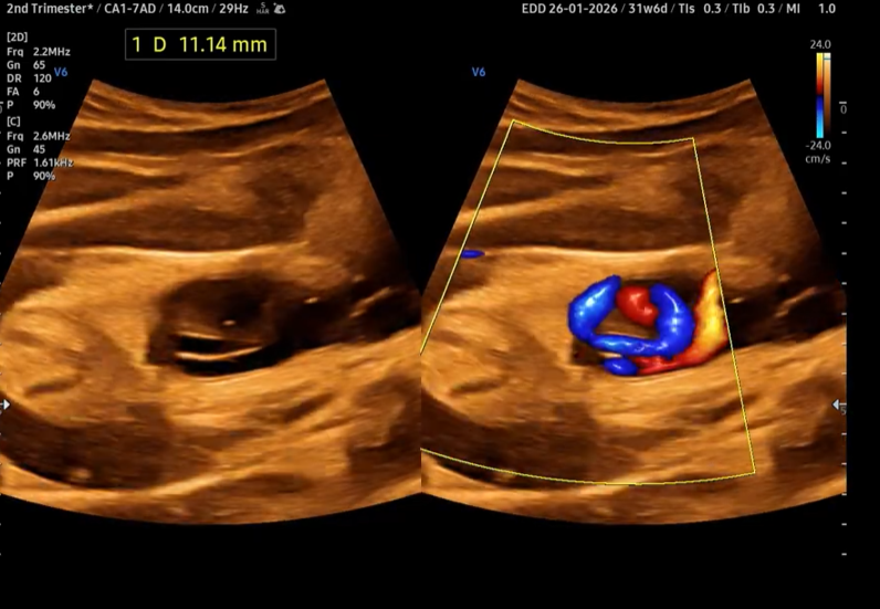 Giãn tĩnh mạch rốn thai nhi (Umbilical Vein Varix - UVV)