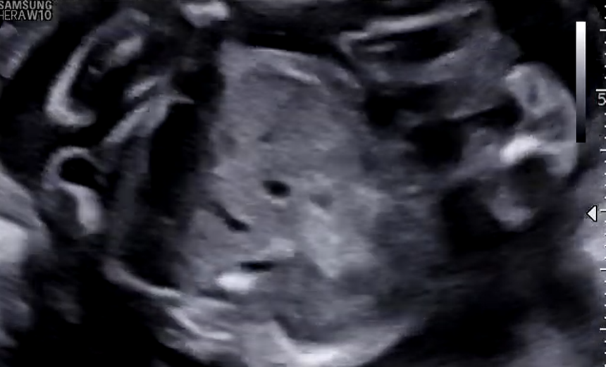 Tồn tại tĩnh mạch rốn phải thai nhi (Persistent Right Umbilical Vein - PRUV)