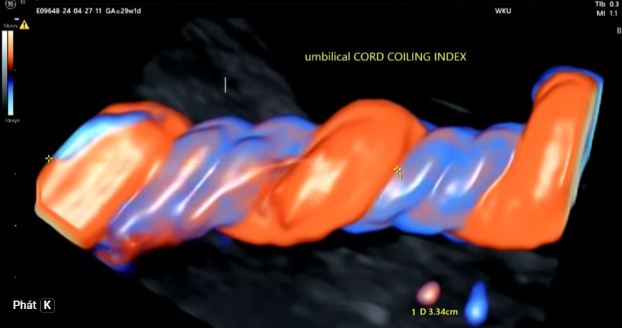 Xoắn dây rốn (Umbilical Cord Coiling)