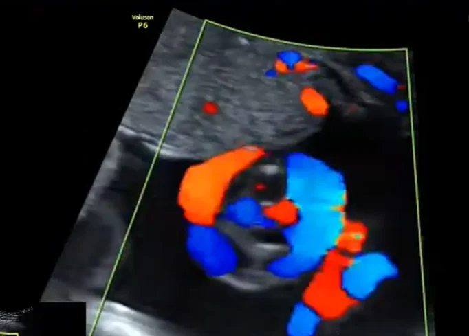 Dây rốn thắt nút (True Umbilical Cord Knot)