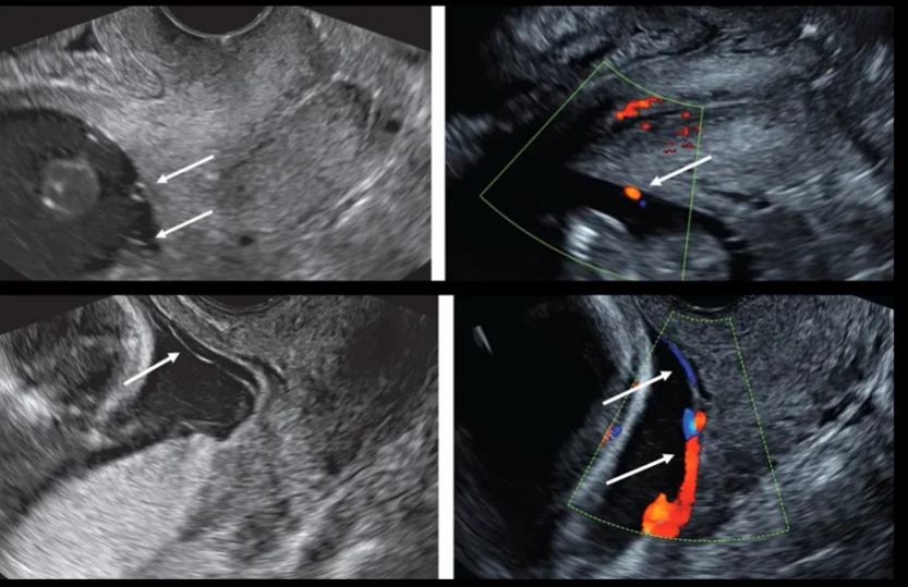 Mạch máu tiền đạo (Vasa Previa )