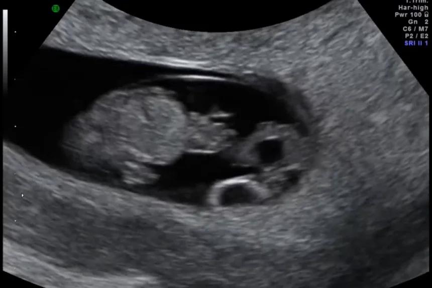 Nang dây rốn (Umbilical Cord Cysts)