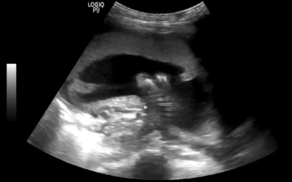 Vách ngăn buồng ối / Dính buồng tử cung (Amniotic Sheets / Uterine Synechiae)