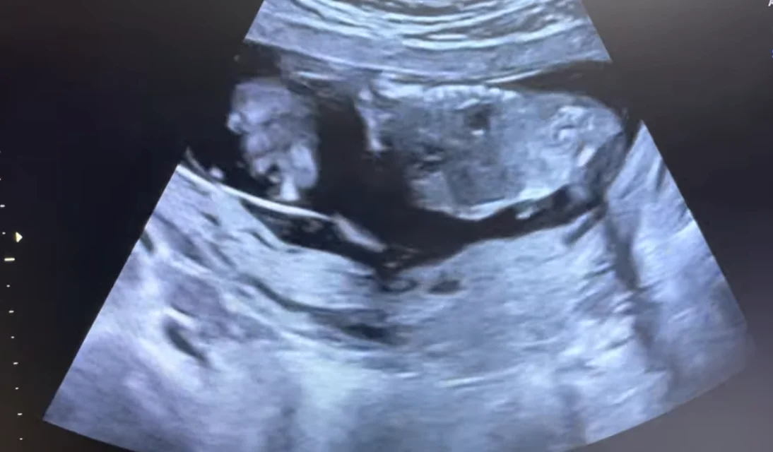 Tách màng đệm - màng ối (Chorioamniotic Separation - CAS)