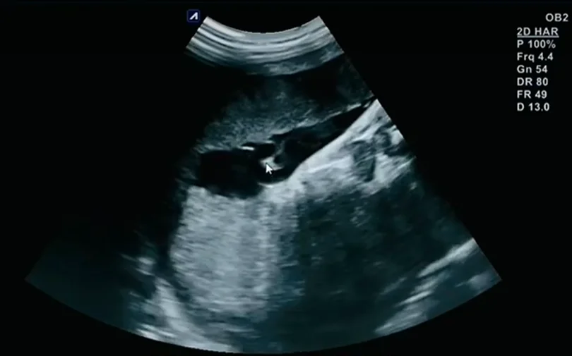 Huyết khối mạch máu rốn (Umbilical Vessel Thrombosis)