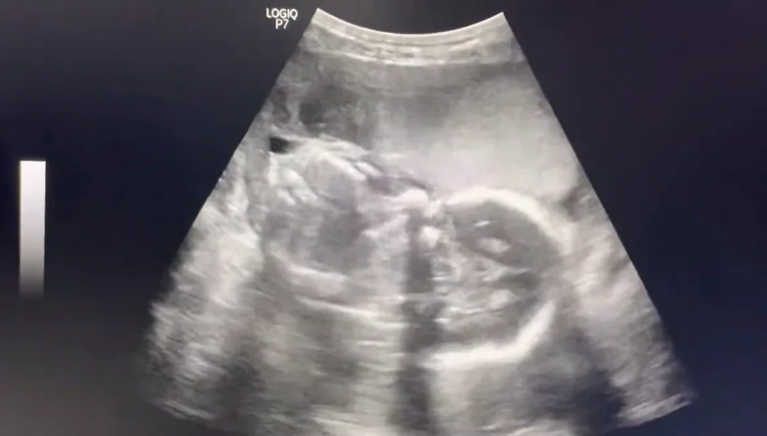 Bánh nhau dày (Placentomegaly)