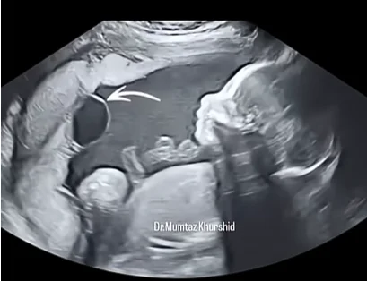 Nang bánh nhau (Placental Cysts)