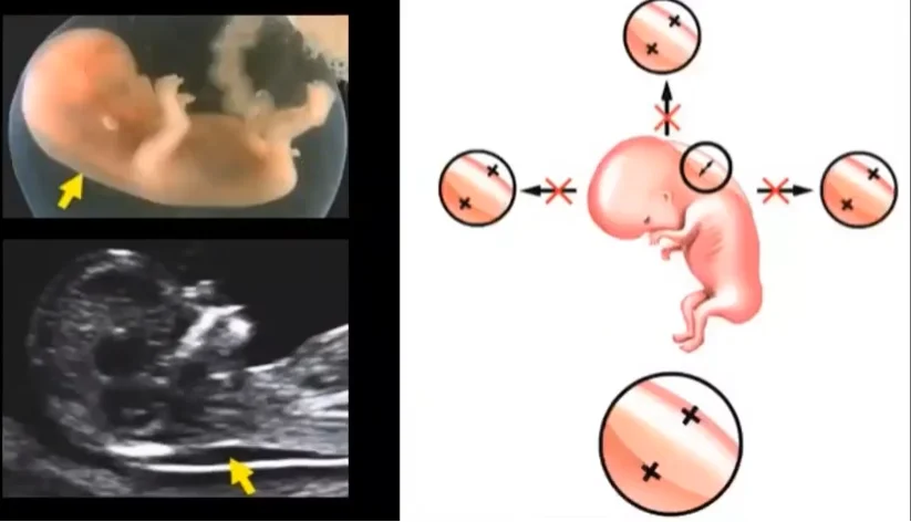Sàng lọc và chẩn đoán lệch bội (Genetic Screening)