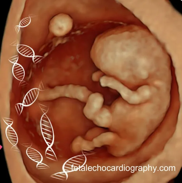 Hội chứng Down (Trisomy 21 - T21)