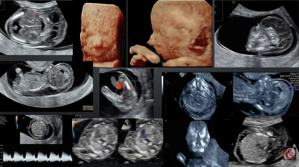 Hội chứng Edwards (Trisomy 18)