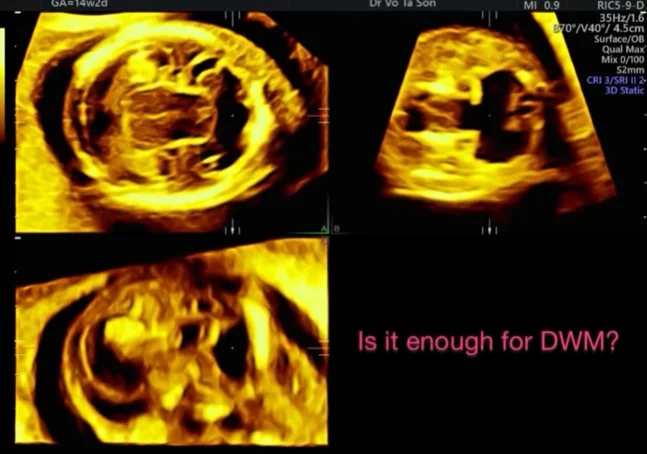 Hội chứng Patau (Trisomy 13)