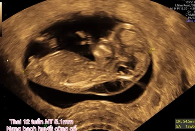 Hội chứng Turner (Turner Syndrome - TS)