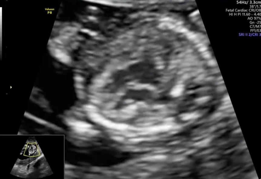 Thể Tam bội (Triploidy)