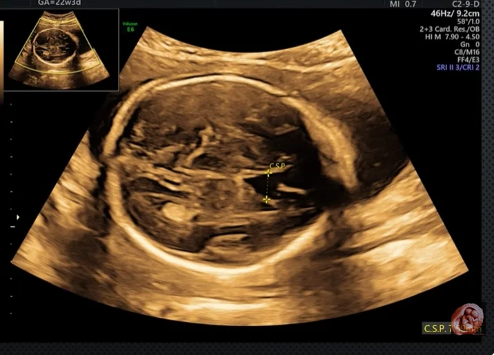 Hội chứng mất đoạn 22q11.2 (Hội chứng Digeorge)