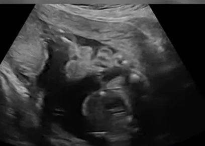 Hội chứng Wolf-Hirschhorn (Wolf-Hirschhorn Syndrome - WHS)