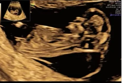 Hội chứng Noonan (Noonan Syndrome - NS)