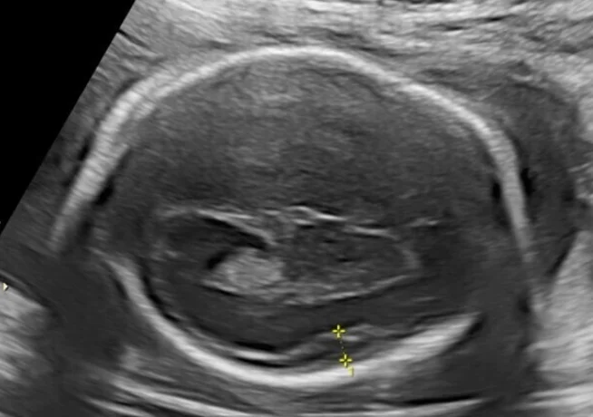 Hội chứng Miller-Dieker (Mất đoạn 17p - Nhẵn não).