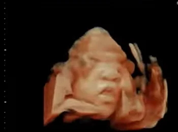 Hội chứng Apert (Dính khớp sọ + Bàn tay găng tay).