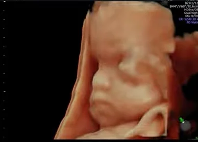 Hội chứng Pfeiffer (Dính khớp sọ + Ngón cái to).