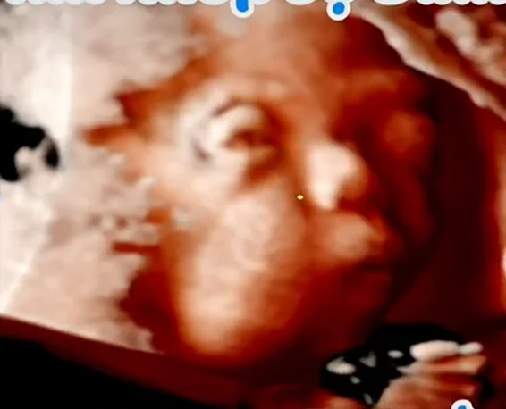 Hội chứng Crouzon (Dính khớp sọ mặt)