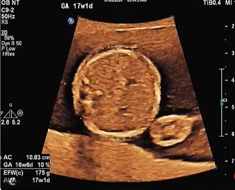Treacher Collins Syndrome (Loạn sản xương hàm mặt)