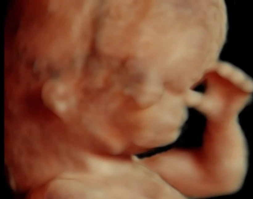 Pierre Robin Sequence (Chuỗi dị tật hàm nhỏ - chẻ vòm)