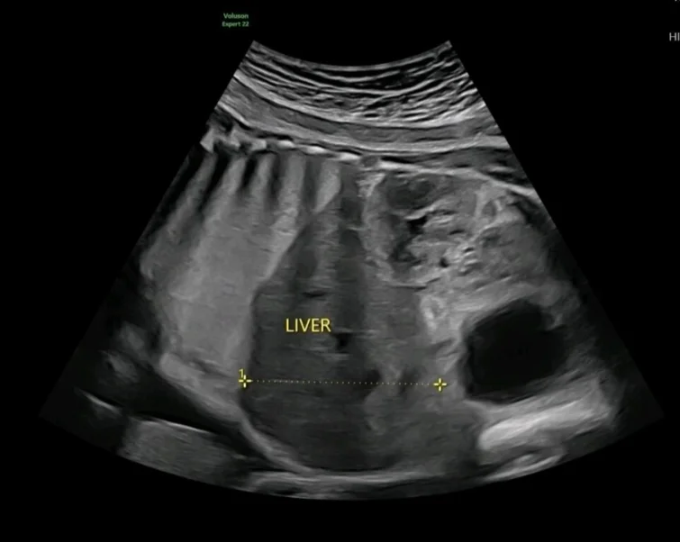 Hội chứng Beckwith-Wiedemann (Tạng to, lưỡi to, thoát vị bụng).