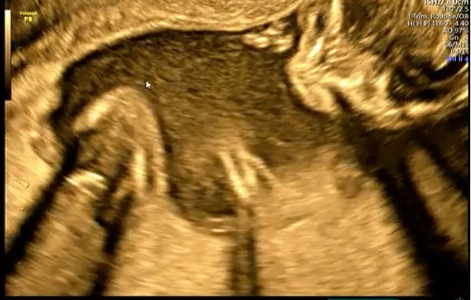 Bệnh xơ nang ở thai- Cystic Fibrosis (Ruột tăng âm)