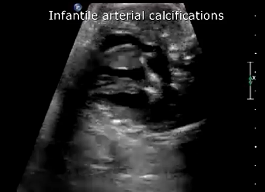 Vôi hóa động mạch sơ sinh vô căn (Idiopathic Infantile Arterial Calcification - IIAC)